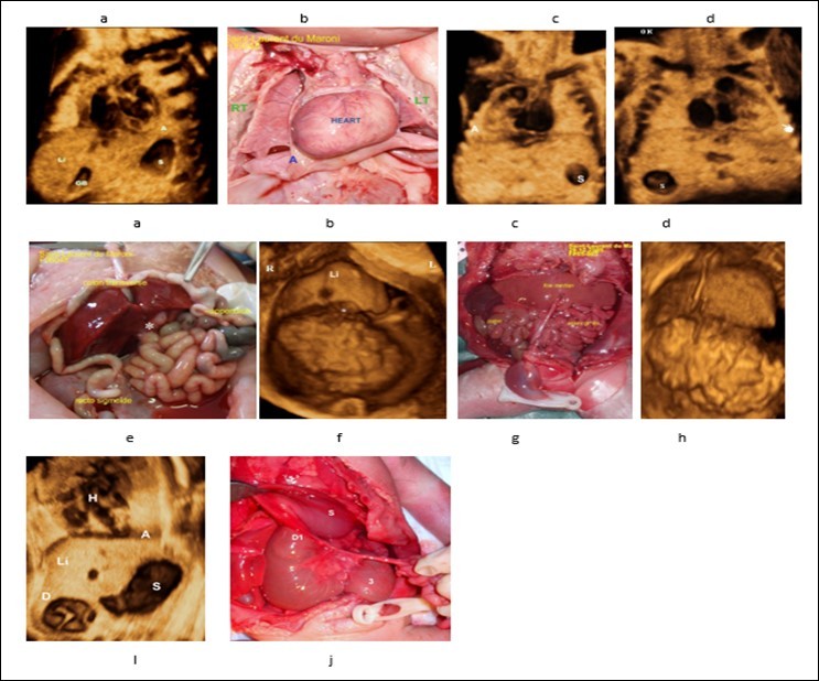 a)Case control, 3D volume of normal situs solitus (28 weeks’ Gestation). The heart and stomach are on the left; the gallbladder is on the right, liver is predominantly on the right side. b,c) Dextrocardia , echo-anatomic correlation. D) Stomach are on the right side , Apex of the heart is on the left.e,f) Liver in the median position (echo-anatomic correlation), appendix and gall bladder ((white  asterisk)  are on the left side, rectosigmoid is on the right side.g)Nonrotation  , the entire small bowel localizing to the right abdomen and colon localizing to the left            abdomen. h- Liver in the median position (echo-anatomic correlation with g). i) Grey scale frontal view, showing the characteristic “double-bubble” appearance of the stomach and           duodenum, note that the apex of the heart is toward the stomach i.e. left side.j) (echo-anatomic correlation with i) D1 first part of duodenum , S stomach , *** Ladd's bands (cause of obstruction).A). Apes of the heart  S: Staomach   R: Right    L: Lefi  Li: Liver .    H: Hand denting apex of the heart   GB: Gall Bladder.