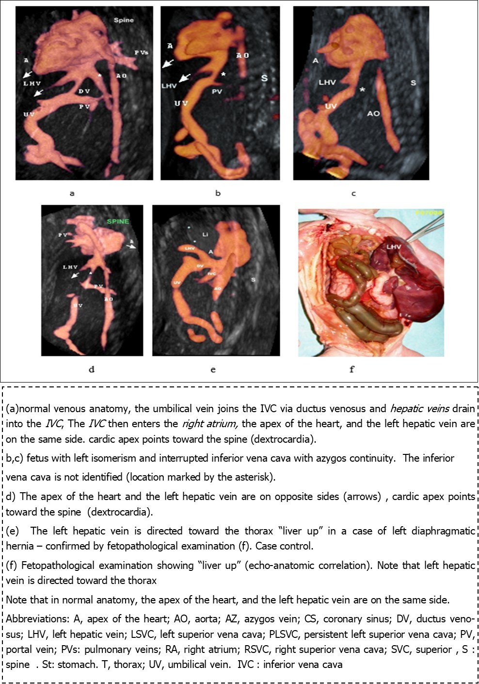 Three-dimensional ultrasound in glass body mode of a parasagittal view