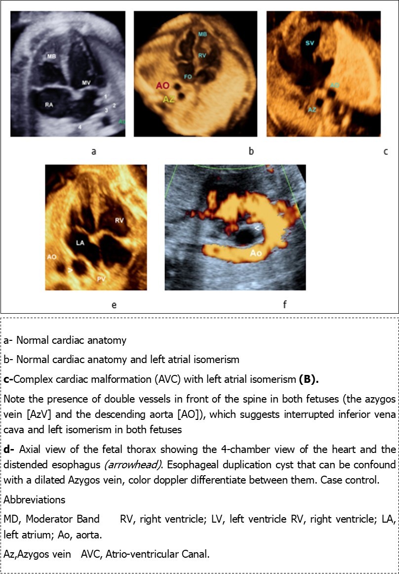 Four-chamber views in four fetuses: