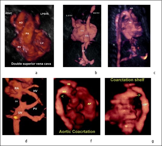a-Three-vessel-trachea view showing the persistent left superior vena cava located left of the pulmonary artery. b-Persistent left superior vena cava draining into the dilated coronary sinus and to the right atrium, the coronary sinus is aneurysmal. c-Three-dimensional ultrasound in glass body mode showing the Azygos vein and Aorta. d- Anomalous hepatic venous drainage directly into the right atrium. e, f- Aortic coarctation (arrow head), note the presence of coarctation shelf (arrow). Abbreviations: RA: right atrium  AO: aorte  UV: umbilical vein  AP : Pilmonary artery   PV: Portal vein  DV : Ductud venosus