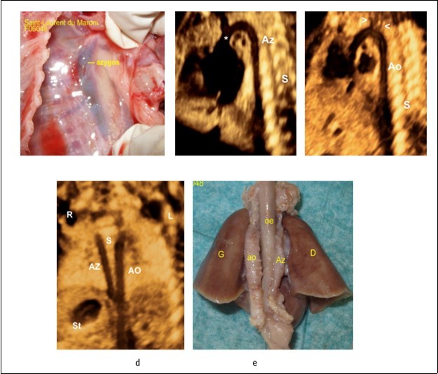 a-Fetopathological examination showing dilated azygos. b- Sagittal image demonstrating the dilated azygos vein and azygos arch connecting to the superior vena cava (*). c-Aortic arche in the same patient, the aortic arche is distinguished from the its branches (arrow heads).e-Coronal planes of the chest and abdomen in a fetus with left atrial isomerism and interrupted inferior vena cava showing the azygos vein (AzV) running parallel and posterior to the descending aorta (on both sides of the spine).f- Fetopathological examination showing azygos and aorta.