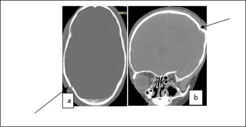 Image of a brain CT scan without contrast agent injection in a bone  window, axial section showing a right parieto-occipital fracture (a), coronal     section showing a left parietal skull depressed fracture (b)