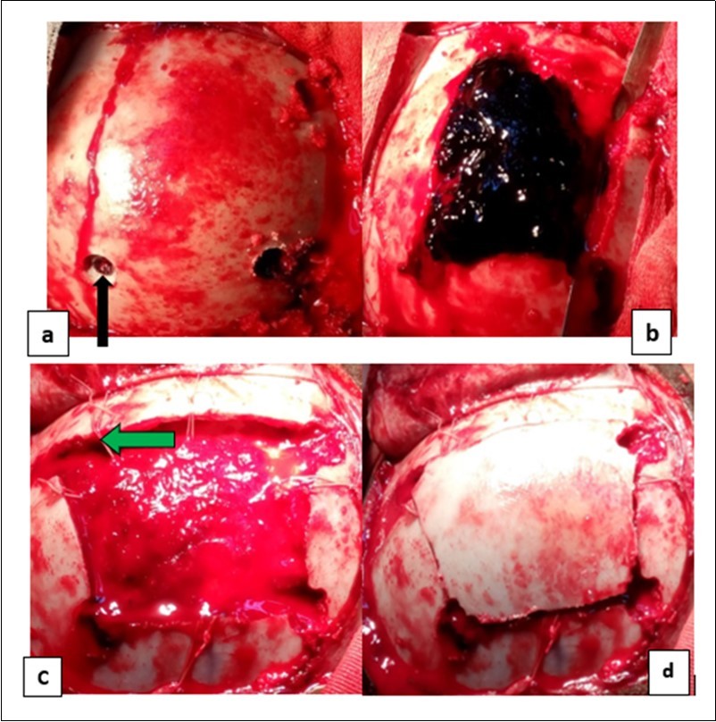 Operating times for an extra dural hematoma: a) making a cranial bone flap with three drill holes (the black arrows); b) extra dural hematoma after            craniotomy (by the blue arrows); c) image showing the dura mater then suspension of the dura mater (the green arrows) and d) image after handing over the bone flap.