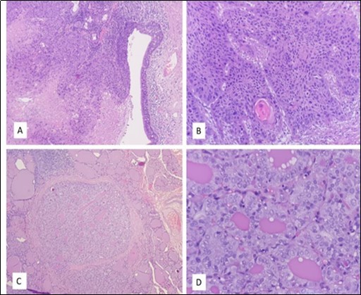 A: Larynx: Full thickness dysplasia of the lining epithelium of the false vocal cord              followed by invasion into the stroma with necrotic area. (H&E x40). B: Larynx: The tumour arranged in nest with moderately pleomorphic nuclei.                      Intercellular bridging, keratin pearl and mitoses are observed. (H&E x100). C: Thyroid: One of the foci of papillary micro carcinoma, surrounded by benign thyroid follicle. (H&E x40). D: Thyroid:  The tumor cells showed enlarged, elongated and overlapping nuclei, irregular nuclear membrane, nuclear grooving and Orphan Annie nuclei (H&E x400)