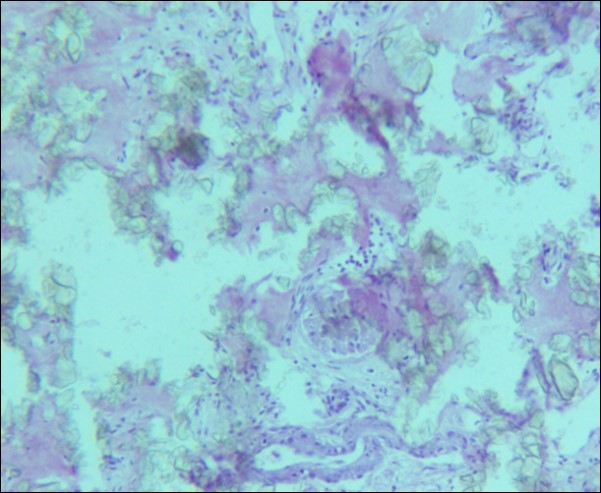 Photomicrograph of renal tissue from case I with a preserved glomerulus and clusters of oxalate crystals in the tubules.