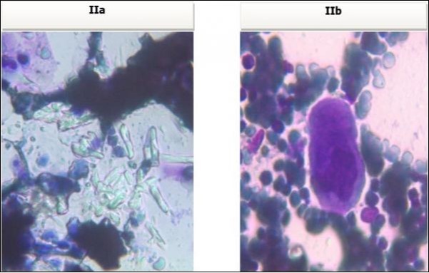 Photomicrograph of bone marrow aspirate from case I revealing oxalate crystals interspersed in the bone marrow fragments and a foreign body giant cell.