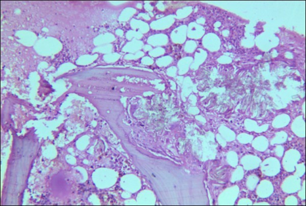 Photomicrograph of bone marrow core from case 1 showing radially arranged calcium oxalate crystals replacing haemopoietic tissue with invasion and destruction of bony trabeculae.  Areas of necrosis and a cluster of hemosiderin laden macrophages is visible.