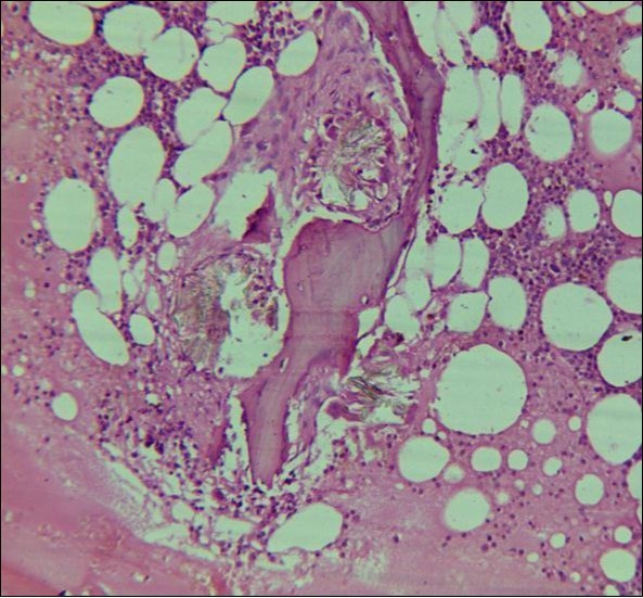 Photomicrograph of bone marrow core from case2 showing Para trabecular arrangement of calcium oxalate crystals. Increased fat spaces and depressed erythropoiesis is evident.