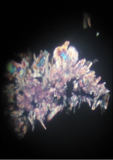 Calcium oxalate crystals showing birefringence under polarized light.