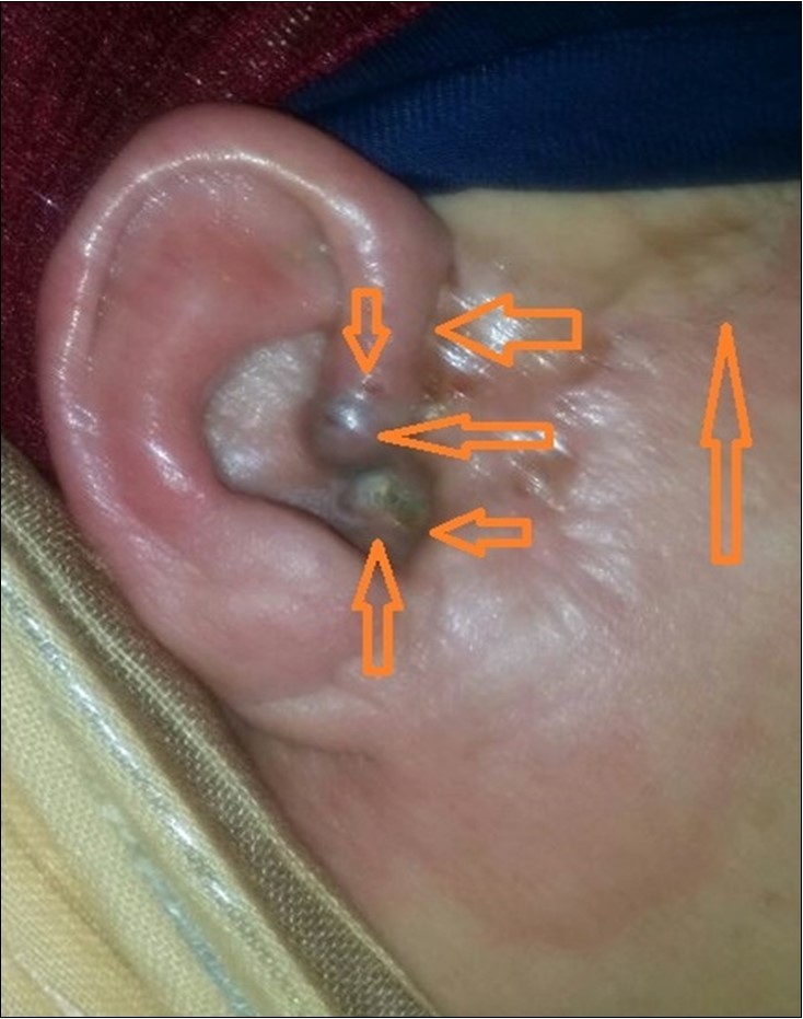 Right ear; Basal Cell Carcinoma (BCC) seen in the skin of ear and adjacent areas, slight edema seen after Bee Venom subcutaneous injection.