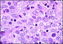 Angiomatoid fibrous histiocytoma enunciating elliptical and spindle-shaped  cells with moderate eosinophilic cytoplasm and intermixed lymphocytes and plasma cells 10.