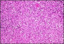 Angiomatoid fibrous histiocytoma exhibiting spherical to elliptical cells comingled with abundant vascularized           stroma and a peripheral accumulation of small lymphocytes with plasma cells 11.
