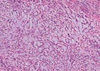 Angiomatoid fibrous histiocytoma enunciating a multinodular pattern with elongated cells, vascular tumour stroma and a border of lymphocytes and plasma               cells12.