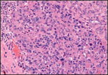 Angiomatoid fibrous histiocytoma exemplifying uniform, spindle-shaped            tumour cells with peripheral lymphocytic cuffing and a vascularized tumour              matrix13.