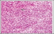 Angiomatoid fibrous histiocytoma            depicting tumour nodules of elliptical cells with a cuff of lymphoid and plasma intermixed with a vascular matrix 15.