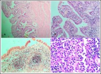 Photomicrographs showing A, Rokitansky agghste sinuses characteristic of chronic cholecystitis; B, Acute on Chronic Cholecystitis; C, Follicular Cholecystitis; D, Foamy macrophages admixed with mcaumulaig          inflammatory infiltrate seen in Zbanikagmapincitma         Cholecystitis (H&E)
