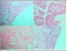 Photomicrograph showing A, cib;k%=Ss in low power; B, High power view of CiNk%=1%us showing lipid laden macrophages; C,ggtj of Gall Bladder; D,             Pyloric Metaplasia Gall Bladder (H&E)