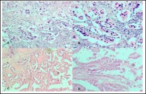 Photomicrograph showing A, Low power                   view of Adenocarcinoma Gall bladder; B, High power view shows attempted gland formation with moderate                  pleomorphismmoderately differentiated adenocarcinoma Gall Bladder; C, Low power view of Papillary carcinoma GB; D, High power view showing papillae with fibrovascular cores lined by malignant cells- Papillary carcinoma GB (H&E)