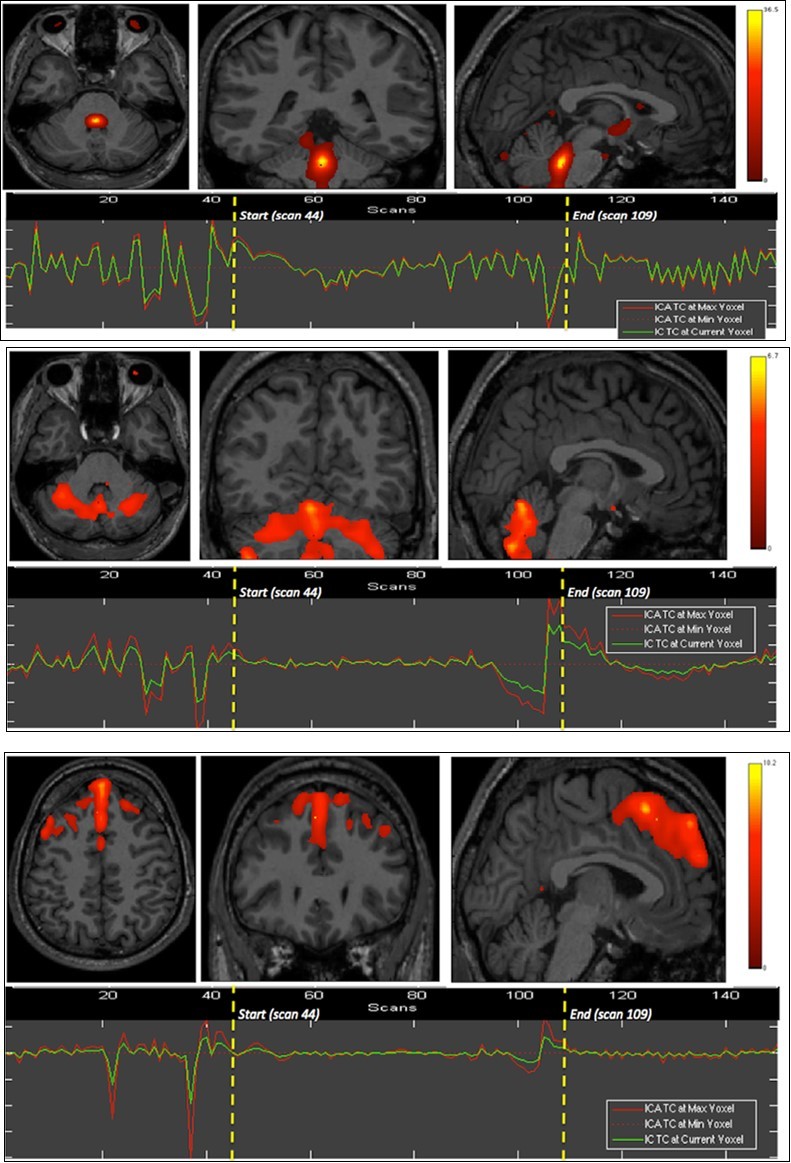 First experiment showing both BOLD signal time courses and activated areas: dorsal pons (1st row), anterior and posterior vermis as well as superior and lateral aspects of the cerebellar hemispheres (2nd row), dorsomedial prefrontal             cortex (3rd row), and primary visual cortex (last row).