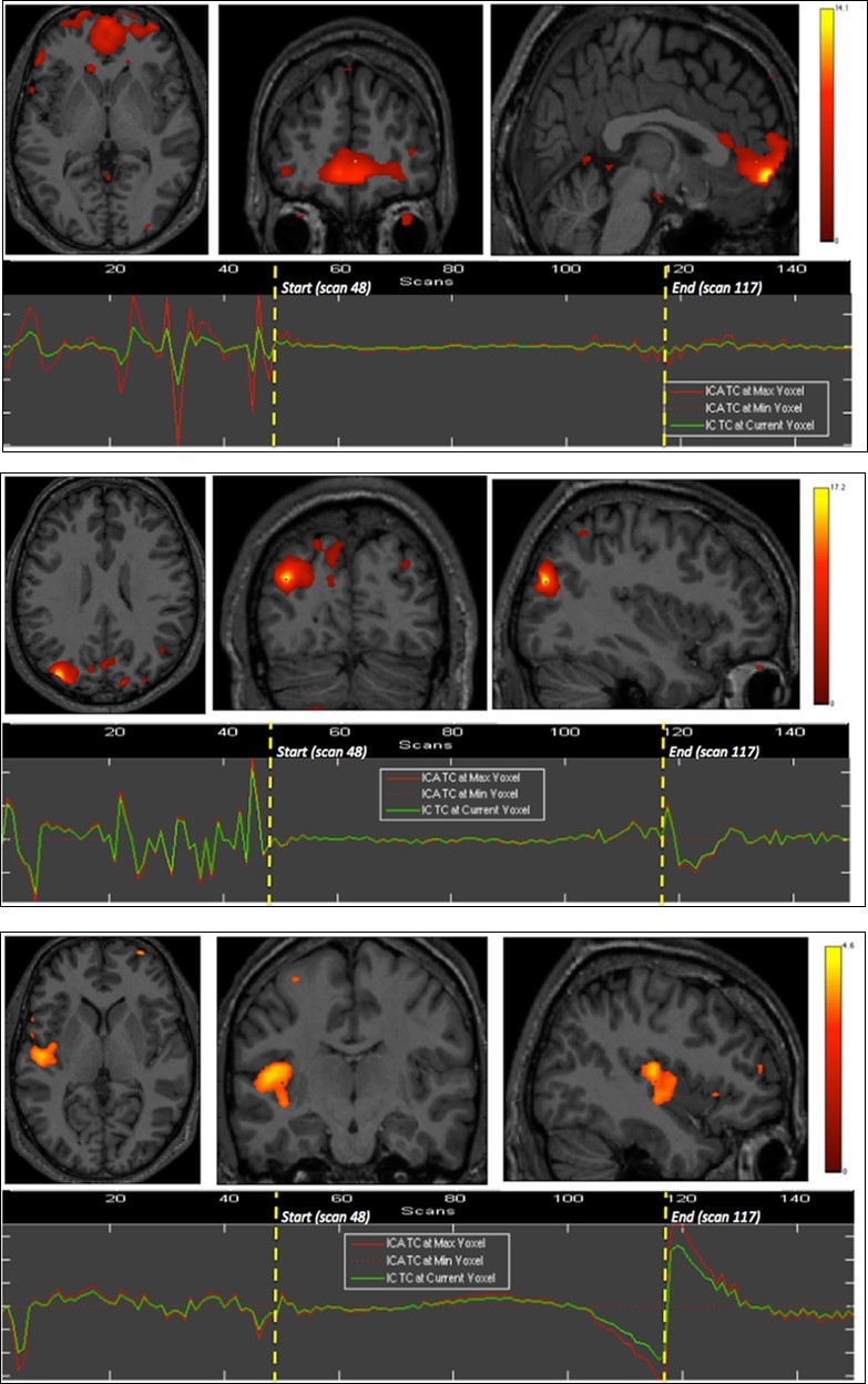Second experiment showing BOLD time courses and activation of                  ventromedial prefrontal cortex (upper row) and inferior parietal cortex including the angular gyrus (middle row) and the supramarginal gyrus (lower row).