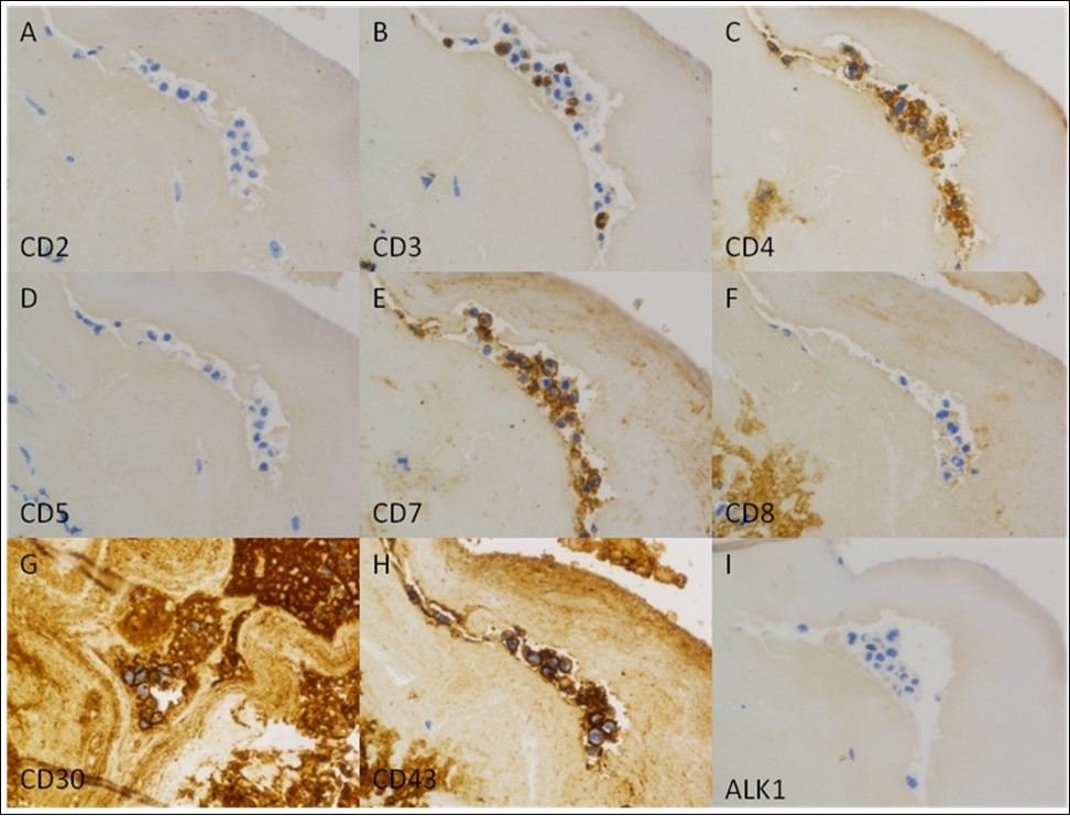 Immunohistochemical characterization of the tumor. The tumor cells are positive for CD3 (subset, B), CD4 (C), CD7 (E), CD30 (strong and uniform, G), and CD43 (H), and negative for CD2 (A), CD5 (D), CD8 (F), and ALK1 (I). (Immunoperoxidase staining; original magnification, x 400).