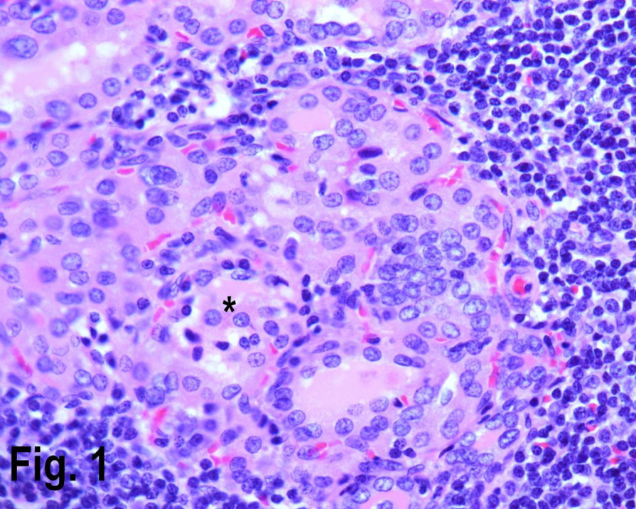 High power view showing Hashimoto’s thyroiditis with lymphocytic infiltrate  in the periphery and Hurthle cells {asterisk} in the center. (Hematoxylin & eosin, original magnification ×400).
