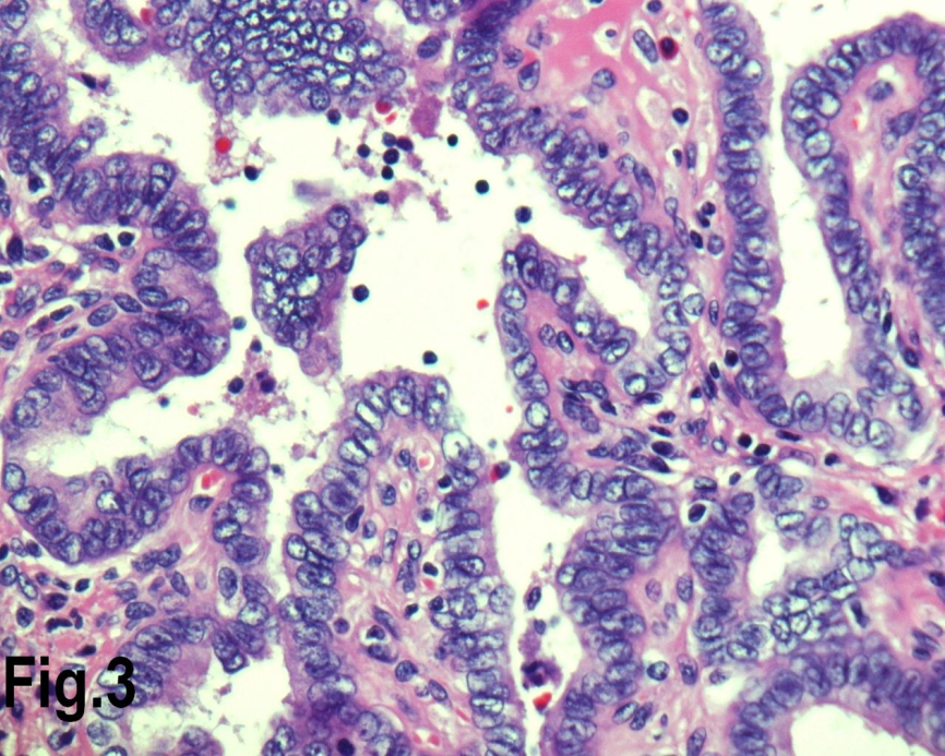 High power view showing follicles lined by cells with nuclear characteristics of papillary carcinoma, with prominent intra nuclear inclusions (Hematoxylin & eosin, original magnification ×400).