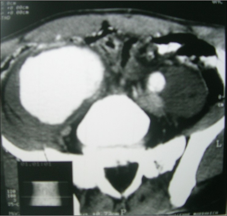 Angio CT scan revealed an aneurysm of the right common iliac artery.
