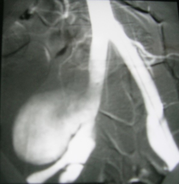 Artégraphie showed the saccular aneurysm.