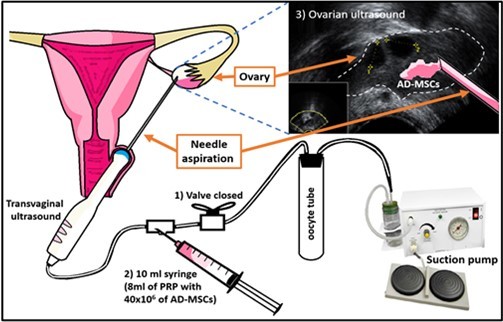 Technique; Application of PRP + AD-MSCs in the ovary; 1) The  aspiration system is closed to prevent PRP + AD-MSCs from going to the oocyte collection tube; 2) PRP + AD-MSCs were injected with the flow of the system directed to the ovary, and 3) It is observed whether PRP + AD-MSCs are deposited in the ovary.