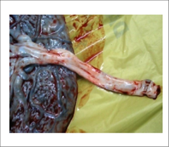 Uncoiled umbilical cord