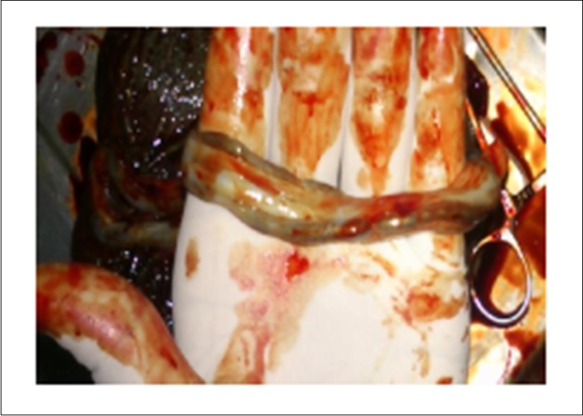 Absence of Wharton's jelly in umbilical cord