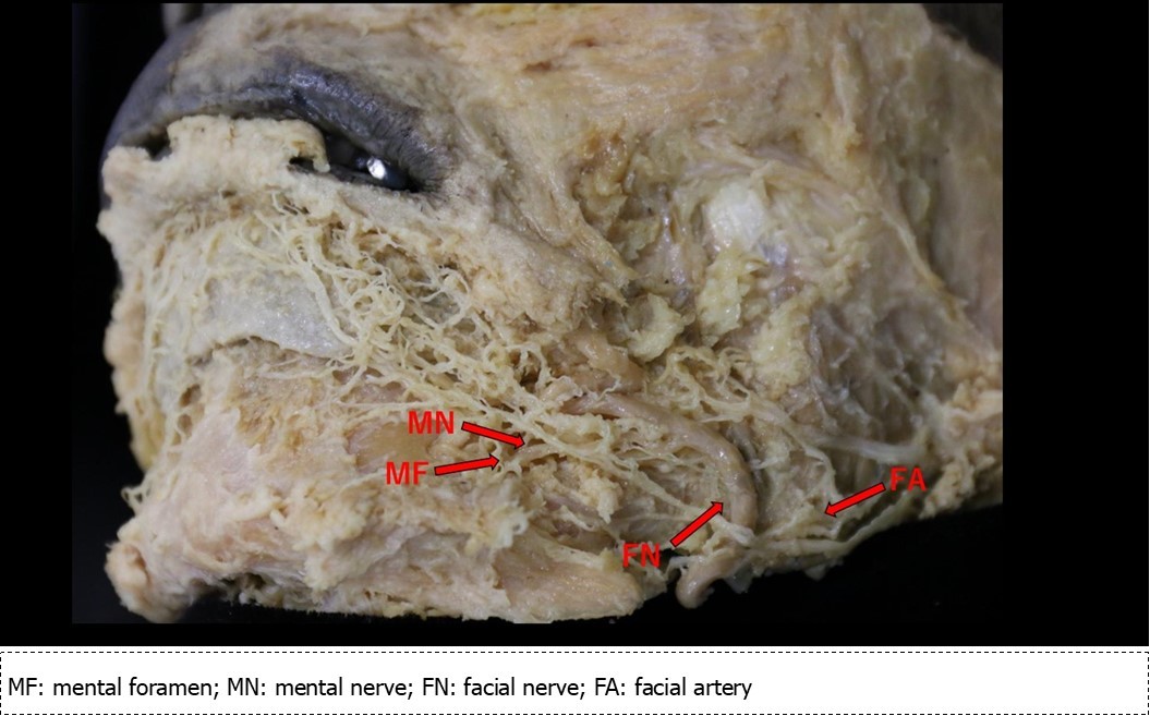 Dissection of the region of the mental nerve and the marginal mandibular branch of the facial nerve