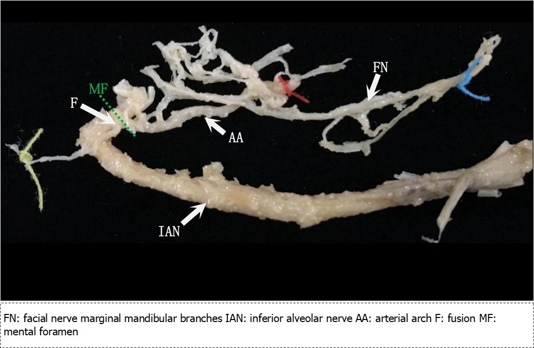 Mental nerve trunk and facial nerve contiguous with the inferior alveolar nerve removed from the              mandibular canal