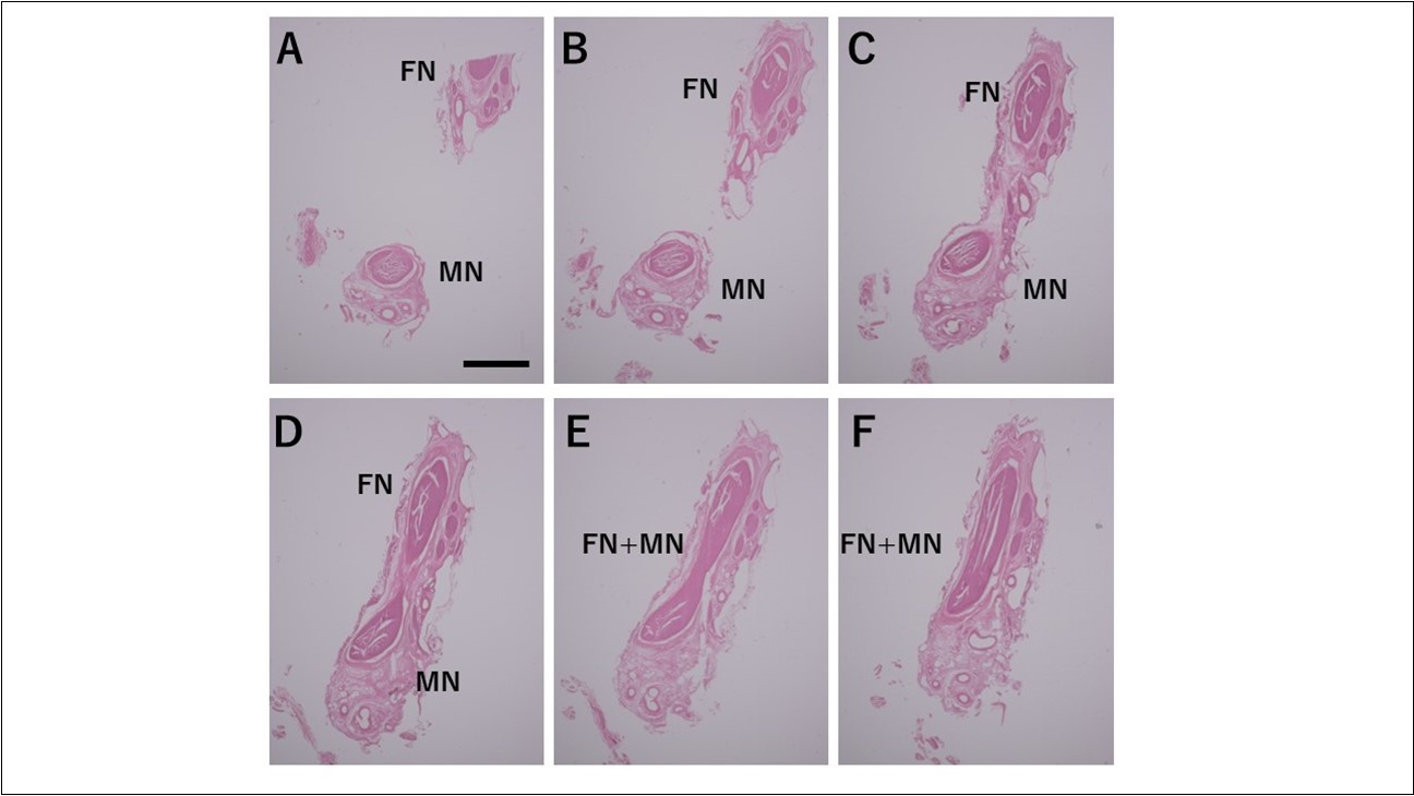Fusion between the inferior alveolar nerve and the marginal mandibular branch of the facial nerve as observed microscopically Bar = 200um
