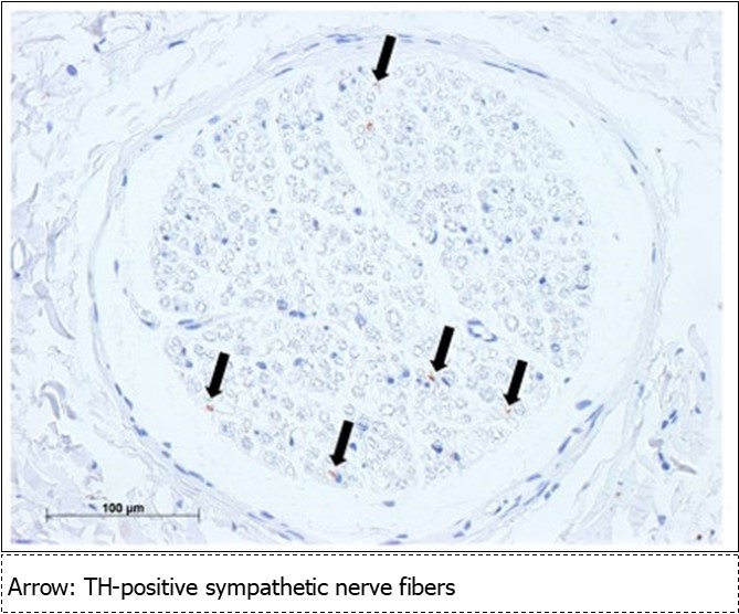 Sympathetic nerve fibers of the mandibular nerve (mental nerve: TH staining) Bar = 100um