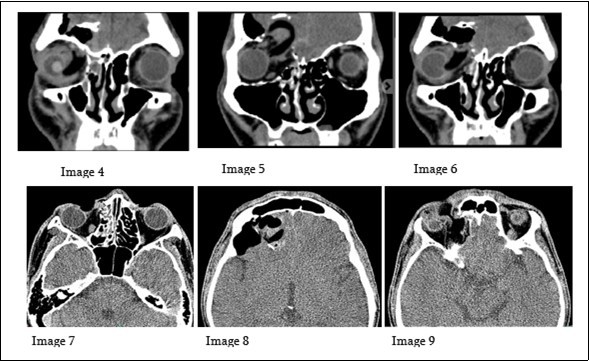 The images (4-6) on the upper row, are serial coronal cuts of the cranial CT scan done for the patient. While images on the lower row (7-9) are axial cuts of the same scan.