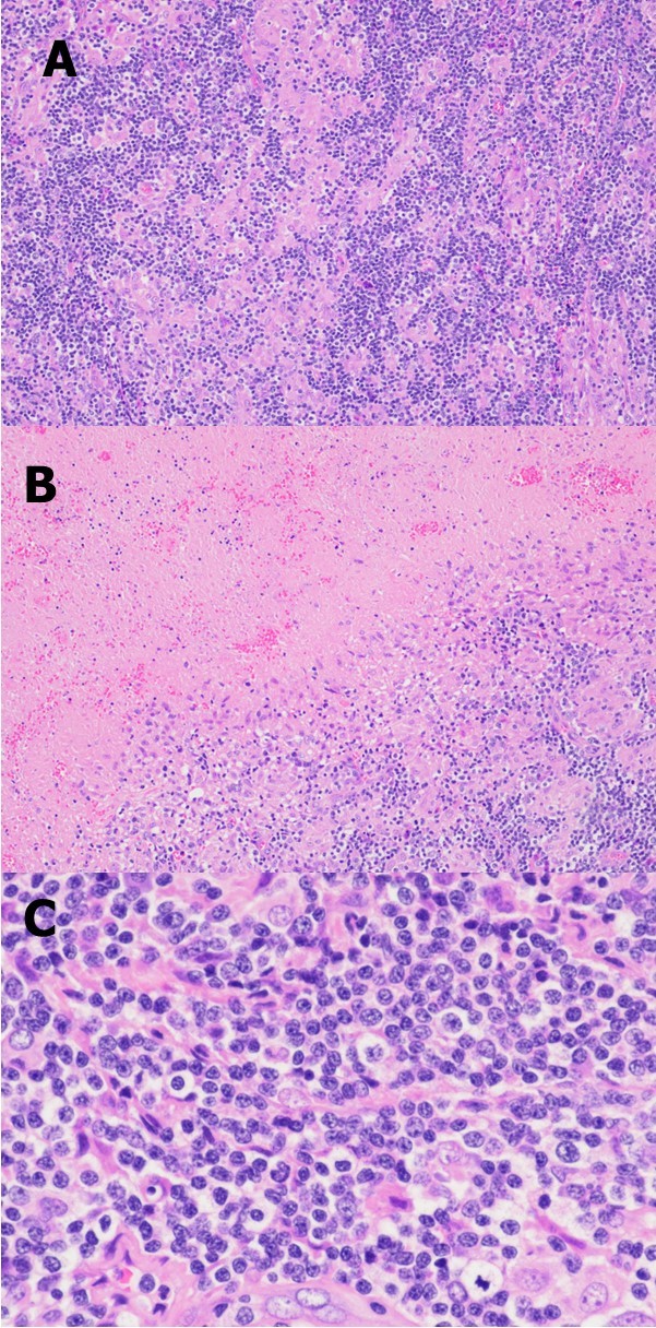 Representative photomicrographs of the excisional biopsy of a right neck lymph node. Low power view showing the lymph node architecture was effaced by a diffuse lymphohistiocytic infiltrate (A) with              extensive geographic necrosis (B). At high power, the lymphocytes are small to intermediate in size; they have round or oval to slightly irregular nuclei, coarse chromatin, and sometimes small nucleoli (C). (H&E stain; original magnification, x 100 A and B, x 400 C).