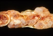 Enchondroma exhibiting a              nodular, encapsulated, well circumscribed, lobulated appearance 12.