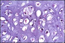 Enchondroma depicting            lobules of hyaline cartilage with             vacuolated cells and eccentric nuclei 12.