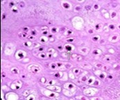 Enchondroma enunciating             lobules of uniform cartilaginous cells with regular, centric nuclei and absence of        mitosis 13.
