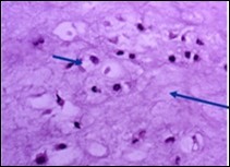 Enchondroma exemplifying lobules of hyaline cartilage composed of enlarged, vacuolated cells with               uniform nuclei. Focal calcification is       absent 14