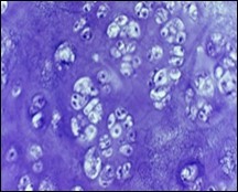 Enchondroma enunciating lobular hyaline cartilage with                   constituent vacuolated chondrocytes an uniform nuclei 15.