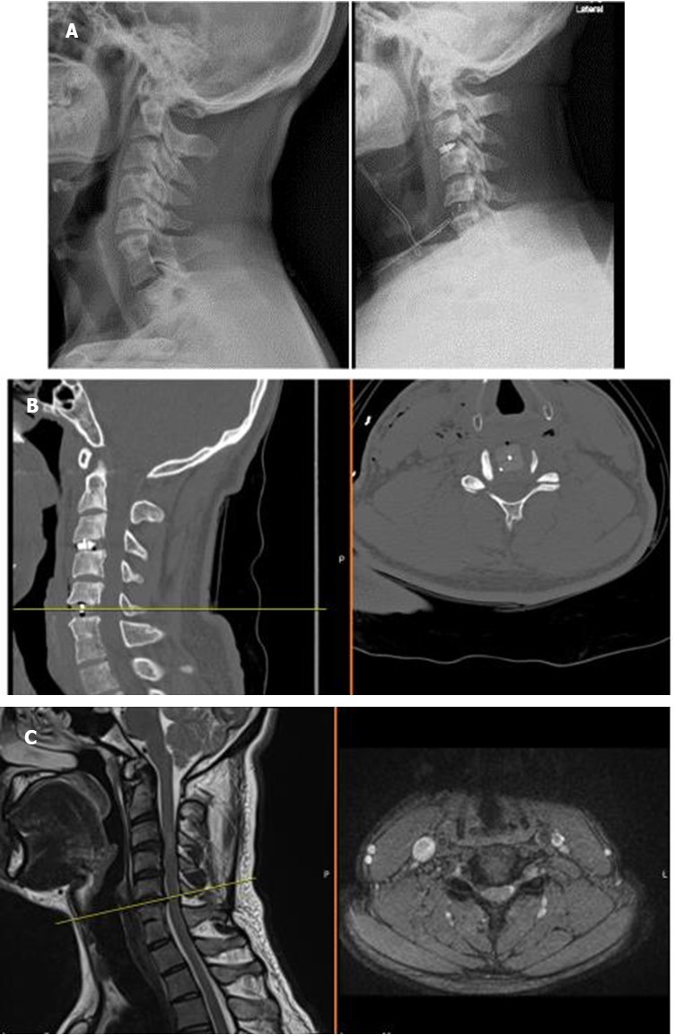 X-ray, computerized tomography, and magnetic resonance              imaging views of a Yilmaz-Yucesoy Classification System Grade 2 patient.