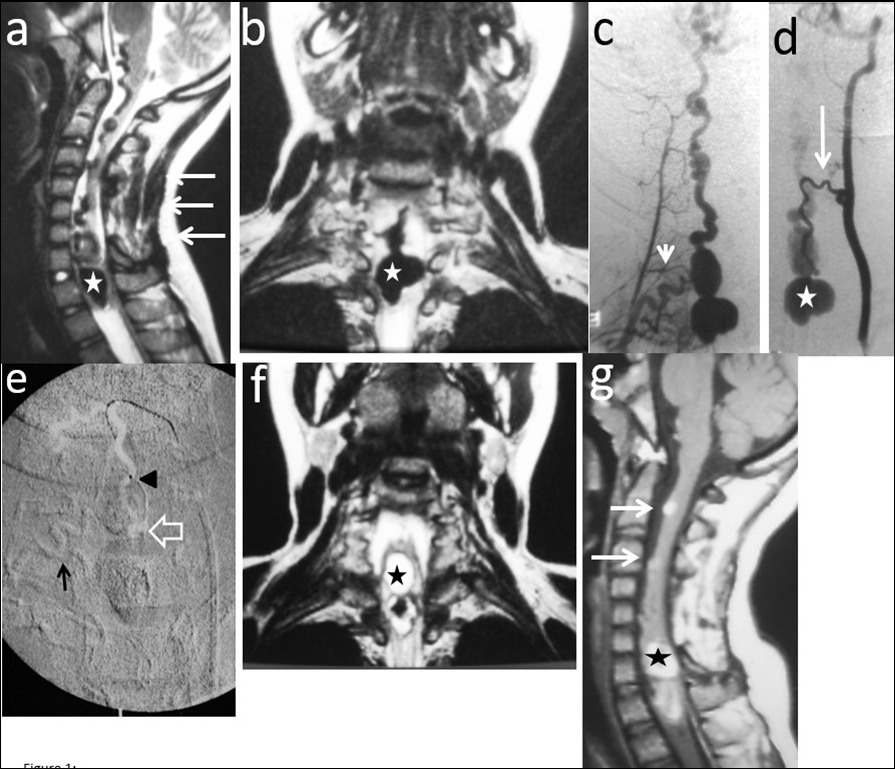 Case # 1: a) T2W sagittal and b) coronal MRI images showing a large bilobed varix in the anterior aspect of the spinal cord at the vertebral levels of C7 and T1 (star). Notice the large venous drainage                 ascending ventrally from the cervical spinal cord towards the brainstem (thin arrow). A previously C3 to C7 “decompressive” laminectomy was performed (arrows). c) Right thyrocervical trunk demonstrates that the main feeder to the fistula is the right artery of the               cervical cord enlargement (short arrow). d) Another feeder from the ASA, branch of the left vertebral artery is visualized (thin arrow). The venous varix is shown (star). e) Roadmap image at the time of micro                catheterization of the left ASA. The tip of the microcatheter (arrowhead) was further advanced to the              fistulous site (open arrow) and 0.8 cc of 90% n-bca in lipiodol was injected. Also notice the glue cast                     injected in the artery of the cervical enlargement (thin arrow).  f) MRI T2W FLAIR coronal and g) sagittal (postoperative day 5) showing fresh clot in the venous varix (star) with retrograde thrombosis of the                  ascending draining veins (arrows). The MR signal of the spinal cord remained normal.