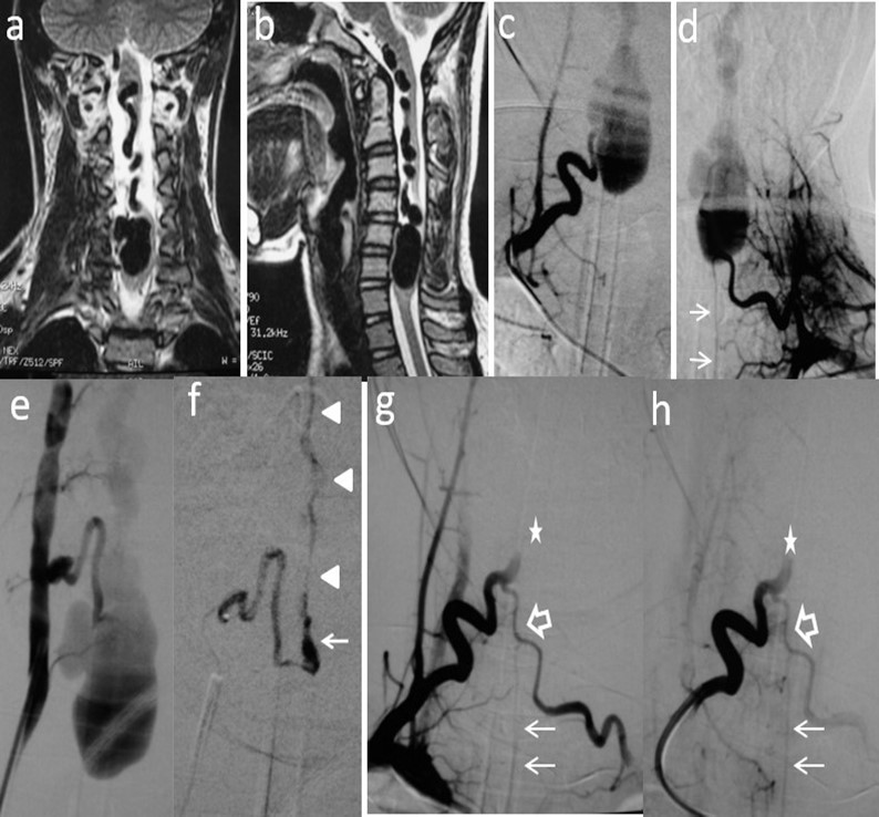 Case # 2: a) Coronal and b) sagittal T2W MRI shows large venous varix compressing                           ventrally the cervical cord at C5-C6 levels causing moderate central hyperintensity above, and mild below the cervical cord. Ascending convoluting draining veins reach the brainstem. c) d) and e)               Angiograms showing right and left arteries of the cervical enlargement as well as a PSA of the right vertebral artery. All of them converge and shunt the varix at the same fistulous point. The ASA branches off the left artery of the cervical enlargement (thin arrows). f) DSA shows the right PSA   feeder catheterized proximally. An injection of 30% n-bca in lipiodol was performed reaching the                             fistulous point (arrow). A thin layer of glue cast is seen in the lateral wall of the ascending vein (arrowheads) g) and h) Post-embolization right ascending cervical artery angiogram showing an                arterial blockade at the entry of the fistulous point (star) preserving its anastomosis with the                       contralateral artery (open arrow). Notice that by reflux, the left artery of the cervical enlargement fills the ASA (thin arrows). Four hours later, the patient suddenly developed quadriplegia probably due to venous and/or ASA thrombosis. Patient lost to follow-up after 2 months.