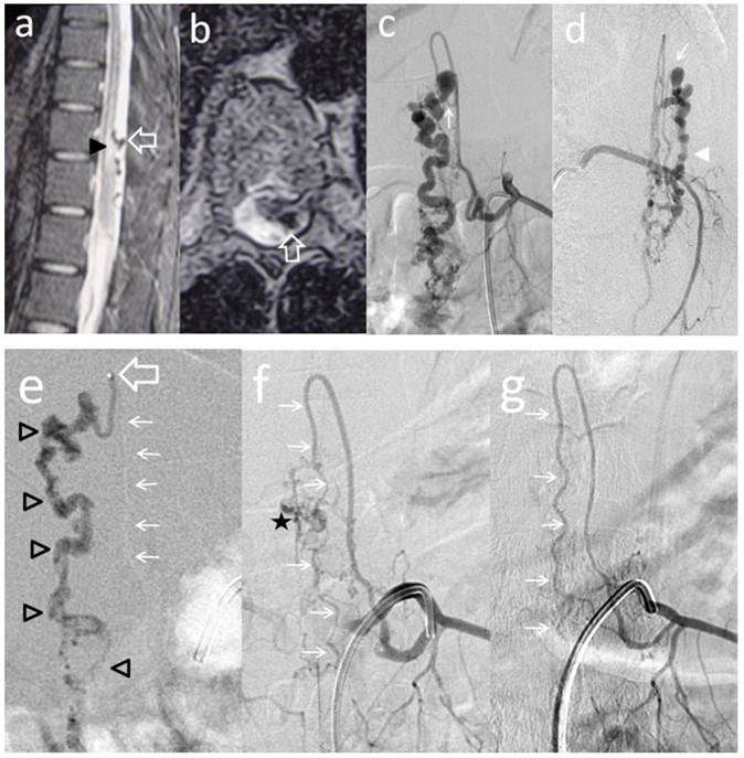 Case # 3: a) T2W MR sagittal and b) axial non contrast spinal MRI, showing flow voids in the   dorsal aspect of conus and epiconus (open arrows) with hypersignal extending towards the lower dorsal spinal cord (arrowhead in a). c and d) Segmental left T11 angiogram in AP and lateral projections. The       artery branches off to an enlarged ASA (Artery of Adamkiewicz) and also a thinner PSA feeding the PMAVF. The fistula is located posterolaterally (thin arrow in c) and d), draining downwards (arrowhead). e)                 Injection of 33% n-BCA with rapid microcatheter removal. See the tip of the microcatheter in the curve of the PSA (open arrow). The glue reached the fistulous site and the draining vein (open arrowheads) f) Left T11 angiogram following embolization did not show any shunt and only remnants of the abnormal draining veins were seen (star) with preservation of the ASA axis (thin arrows). g) An angiogram performed 3 months postembolization demonstrated complete eradication of the AVF and preservation of the artery of Adamkiewicz (thin arrows).