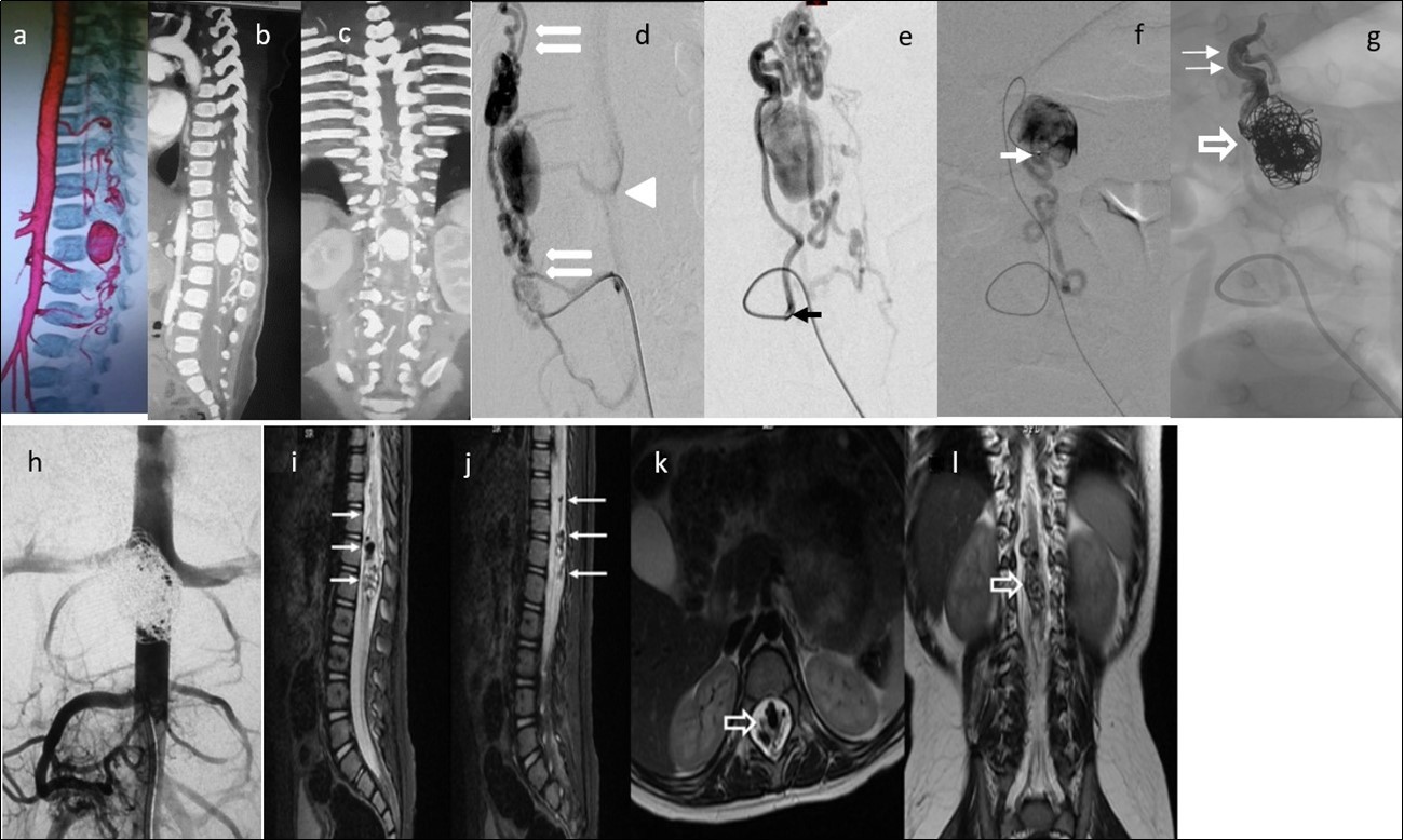Case 4: a) 3D CTA shows a gigantic venous pseudoaneurysm occupying the spinal canal at the              T12-L1 vertebral levels with tortuous veins above and below the lesion. b) and c) 2D reformatted images. d) and e) Selective right L3 angiogram through a 4F guiding catheter (arrow) in lateral and AP projections              showing an enlarged PSA feeding a huge venous varix with ascending and descending perimedullary veins (thin arrows) and with segmental epidural draining veins at the fistula level (arrowhead).f) A microcatheter was navigated up to pseudoaneurysm (arrow) g) In the venous sac, 21 GDC coils were deployed (open arrow) and the microcatheter tip was pulled back to the fistulous site followed by Onyx 18 injection to fill up the foot of the ascending draining vein (thin arrows). h) Post-embolization abdominal aortogram (late phase) failed to demonstrate any remaining shunt. i) to l) Multiplanar T2 MR images 6 months’ post-embolization showing  absence of flow, and artifacts due to coils and Onyx (arrows). No spinal cord hyperintensity was observed. Patient starting to walk independently with minimal right foot dorsiflexion paresis. He gained complete             sphincter control.