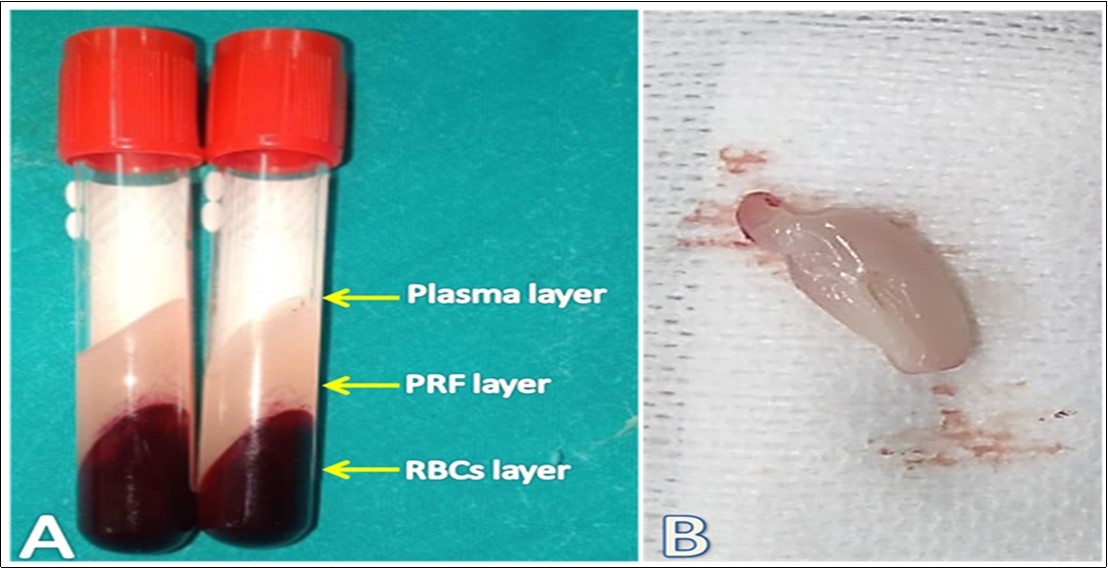 Preparation of autogenous PRF. A: The blood in a plain tube was separated into three distinct layers where the middle layer, a strong fibrin clot, represents the                    leukocyterich PRF. B: A clean yellowish white PRF clot was obtained after whipping the adhered RBCs layer off on a sterile gauze pad.
