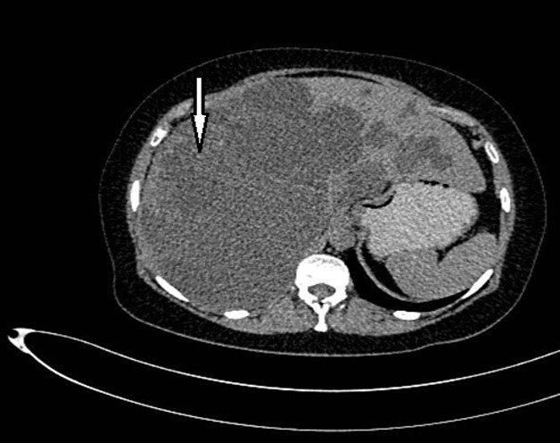 Non-contrast CT shows hepatomegaly by multiple clusters of cysts.